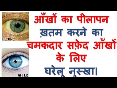 आँखों का पीलापन