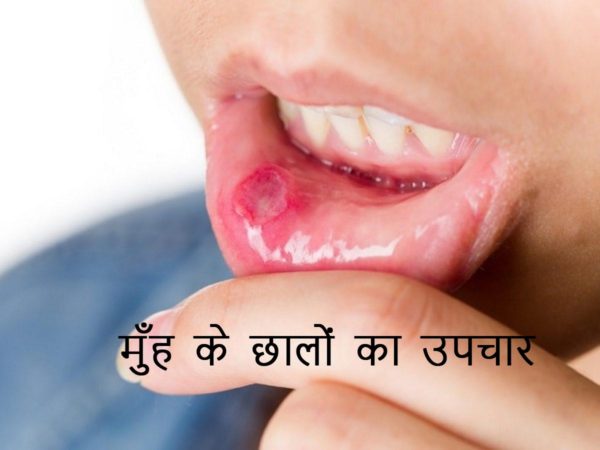 मुँह में छाले