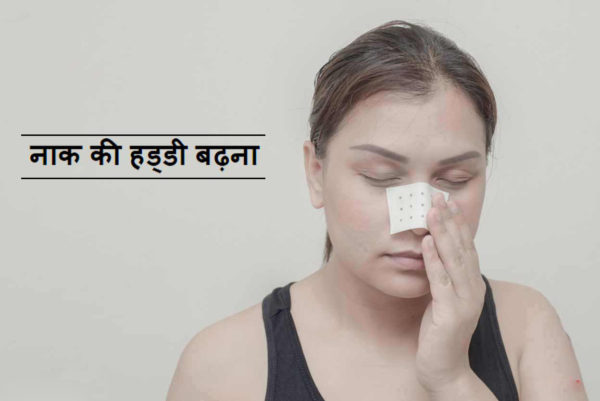 नाक की हड्डी बढ़ जाना