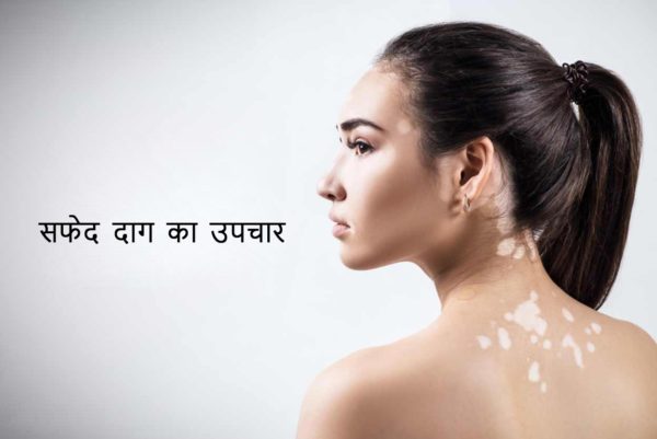 स्वेतप्रदर (सफ़ेद दाग)