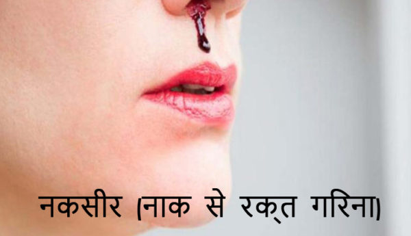 नकसीर (नाक से रक्त गिरना)